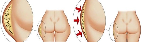 Эффективные способы убрать глифе на бедрах