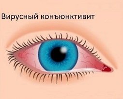 Вирусный конъюнктивит у ребенка 