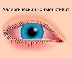 Аллергический конъюнктивит у ребенка 