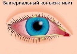 Бактериальный конъюнктивит у ребенка 