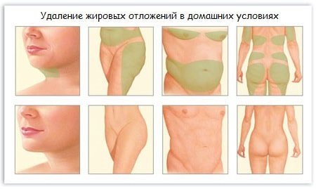 5 советов для удаления жировых отложений в домашних условиях 5 советов для удаления жировых отложений в домашних условиях