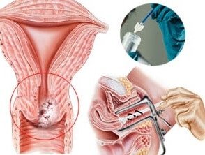 Цитологическое исследование шейки матки 