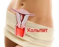 Лечение кольпита 