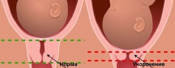 Норма и укорочение Норма и укорочение