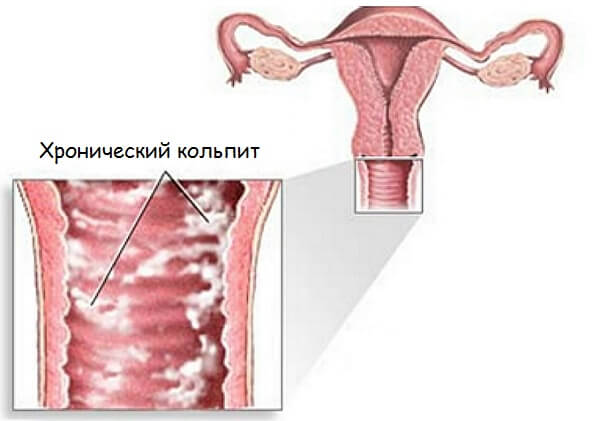 Хронический кольпит 