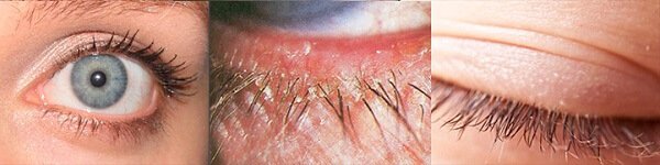 Клещи на ресницах демодекс Клещи на ресницах демодекс