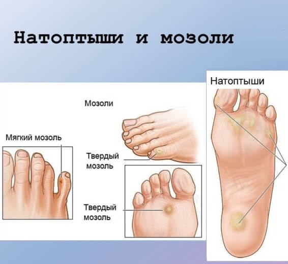 Сухие мозоли на ногах и натоптыши 